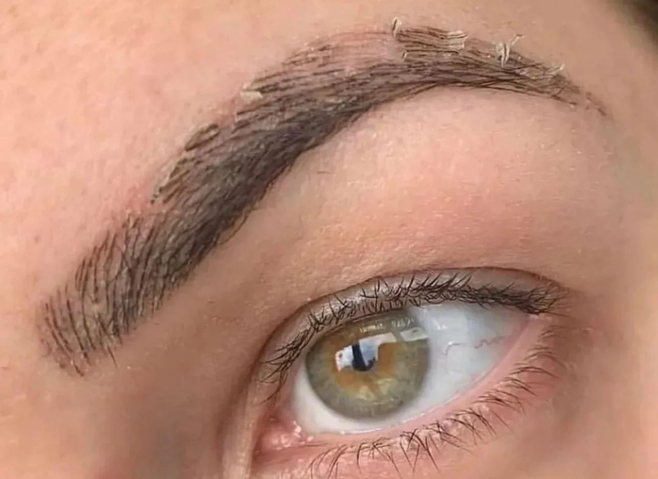 Rimozione del tatuaggio senza laser, Ytllo Beauty Roma