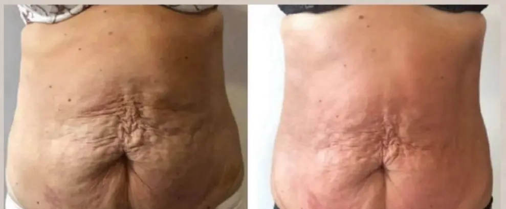 Endospheres Therapy, Hello Beauty Roma