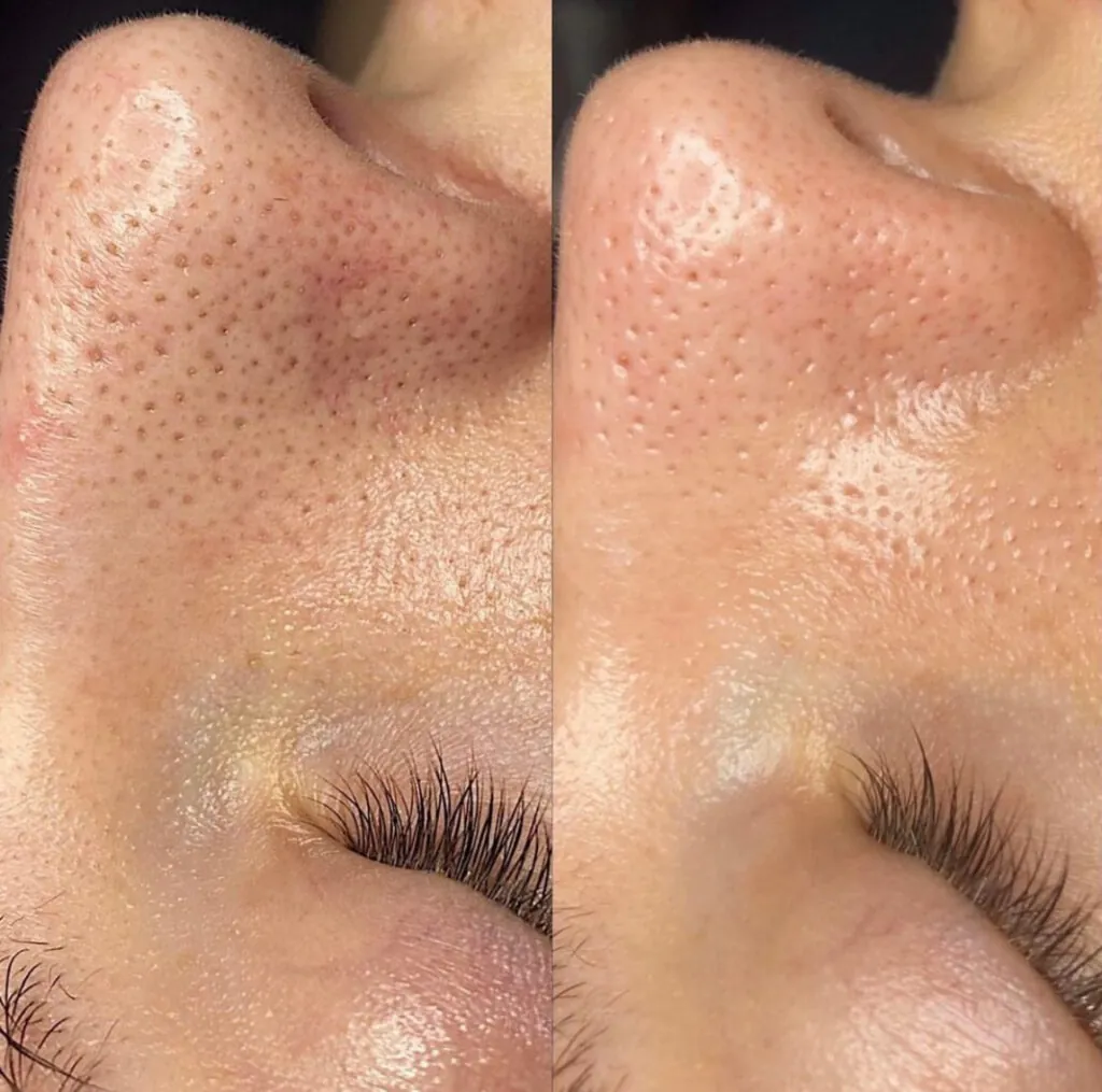 Pulizia del viso profonda IS CLINICAL, Hello Beauty Roma