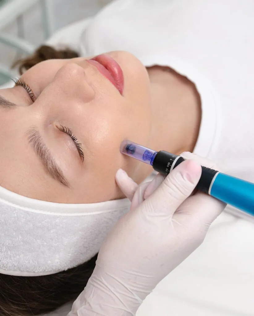 Microneedling Viso Post Acne, Hello Beauty Roma