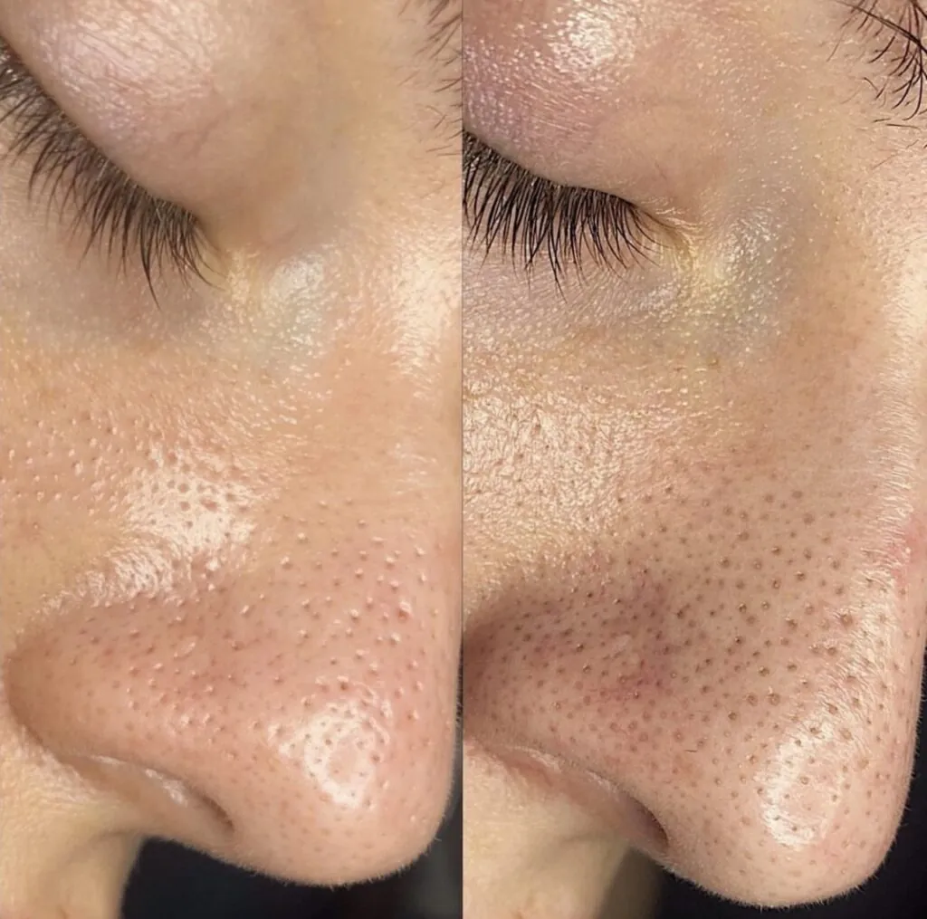 Pulizia del viso profonda IS CLINICAL, Hello Beauty Roma