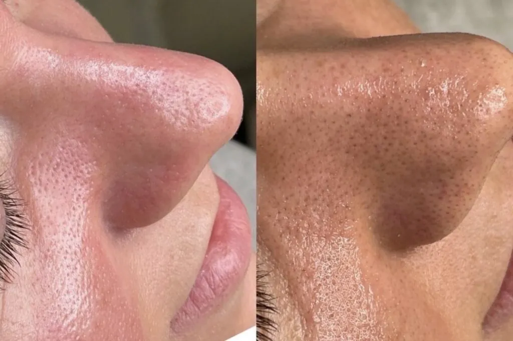 Pulizia del viso profonda IS CLINICAL, Hello Beauty Roma