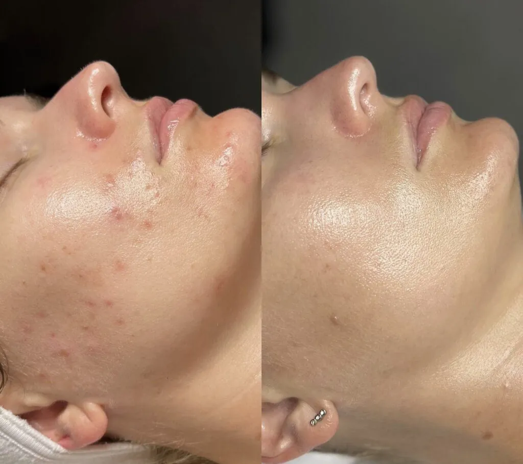 Trattamento Anti Acne, Hello Beauty Roma