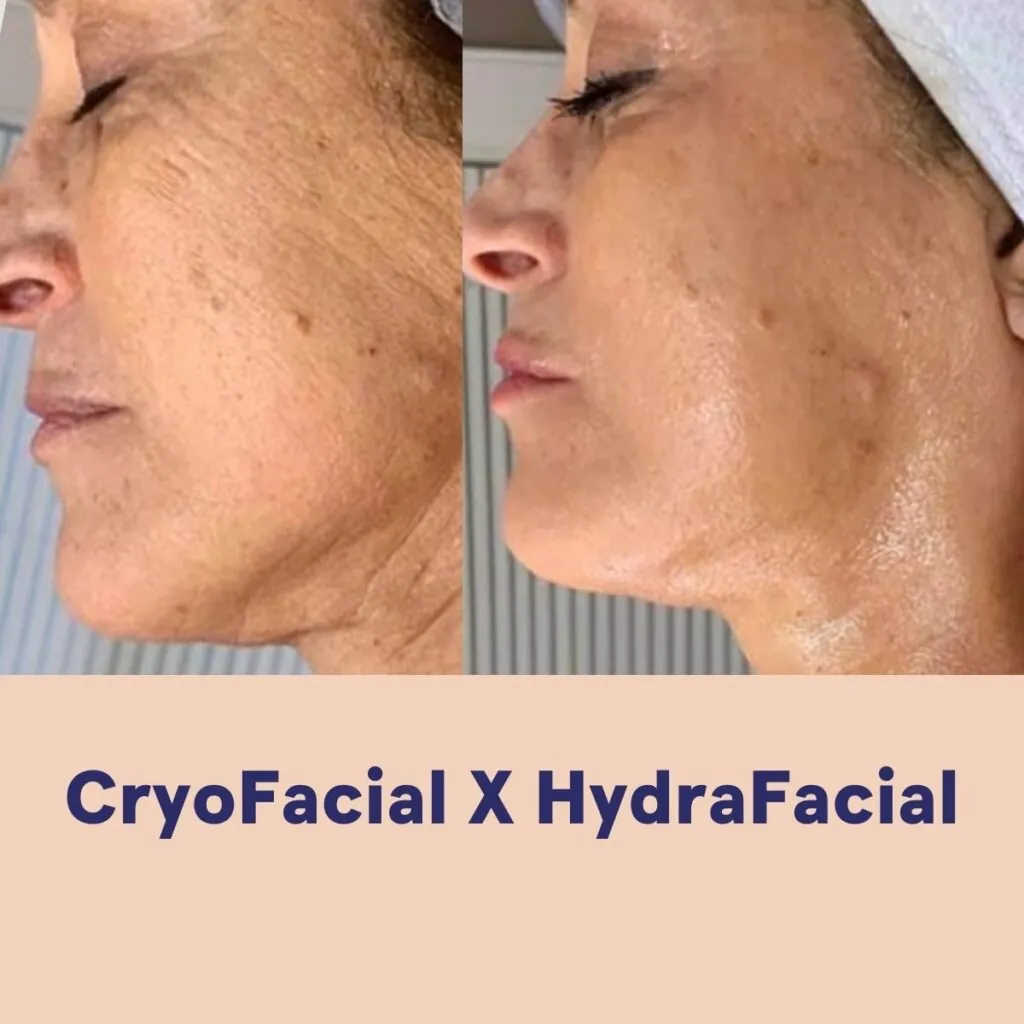 HYDRAFACIAL DIAMOND, Hello Beauty Roma