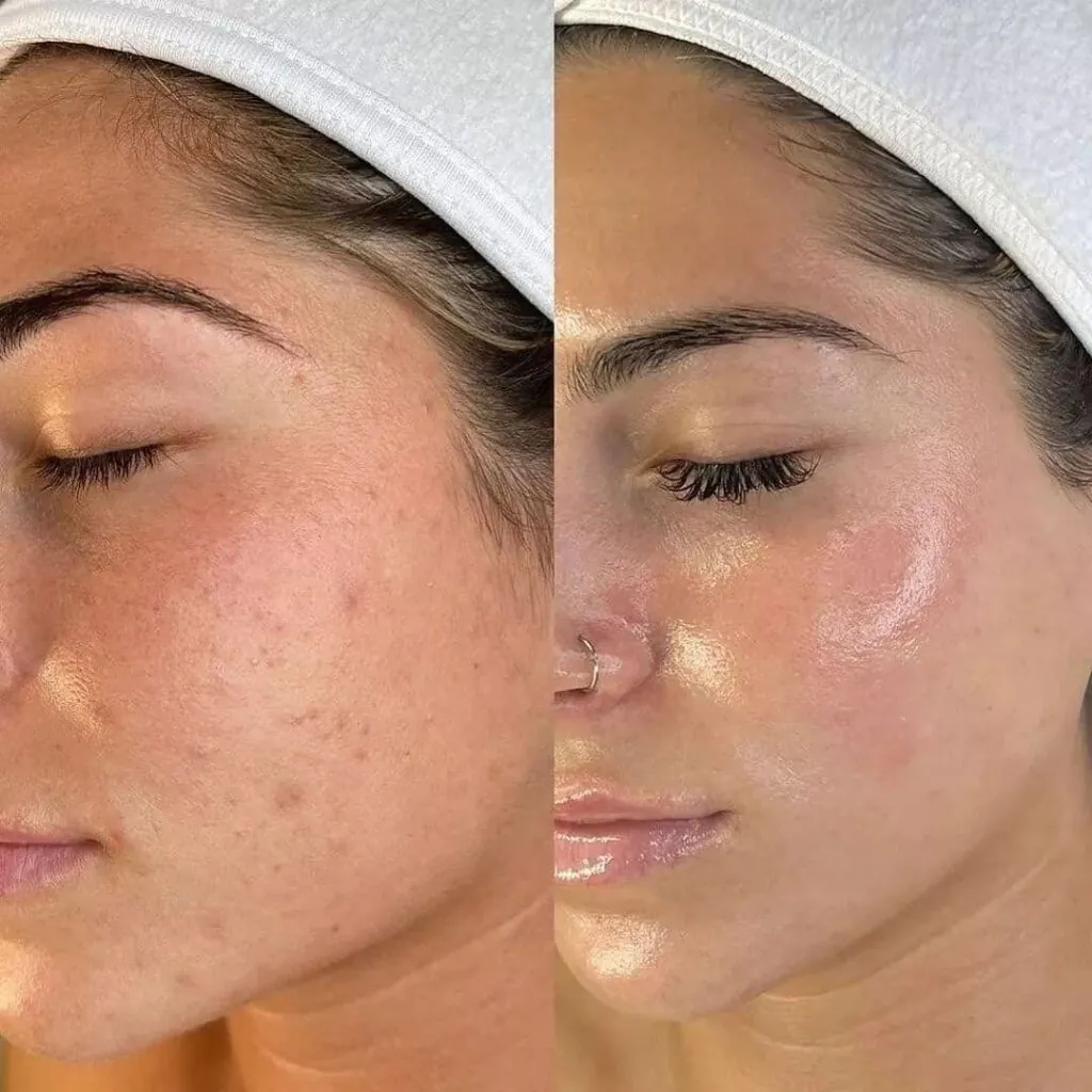 Pulizia del viso profonda IS CLINICAL, Hello Beauty Roma