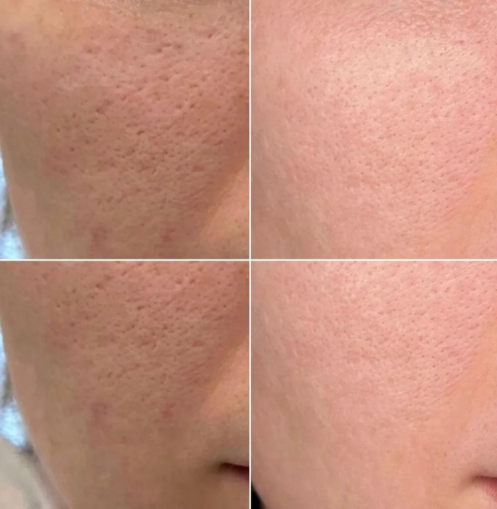 Microneedling viso e collo, Hello Beauty Roma