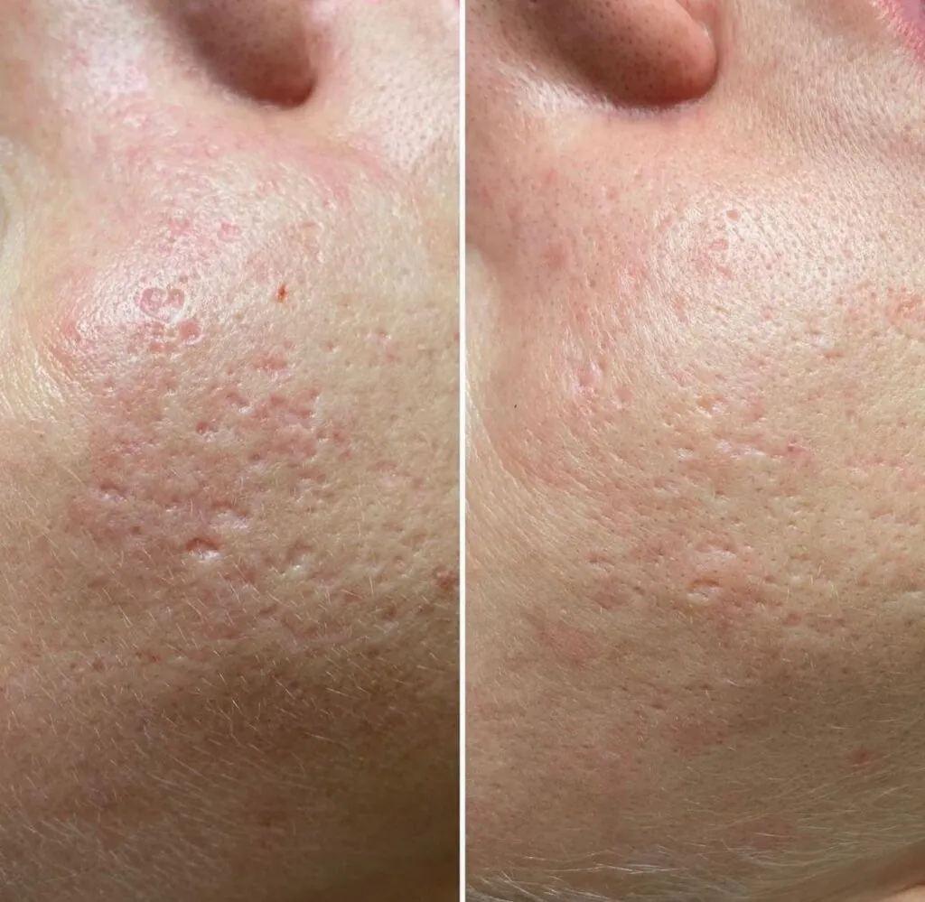 Microneedling viso e collo, Hello Beauty Roma