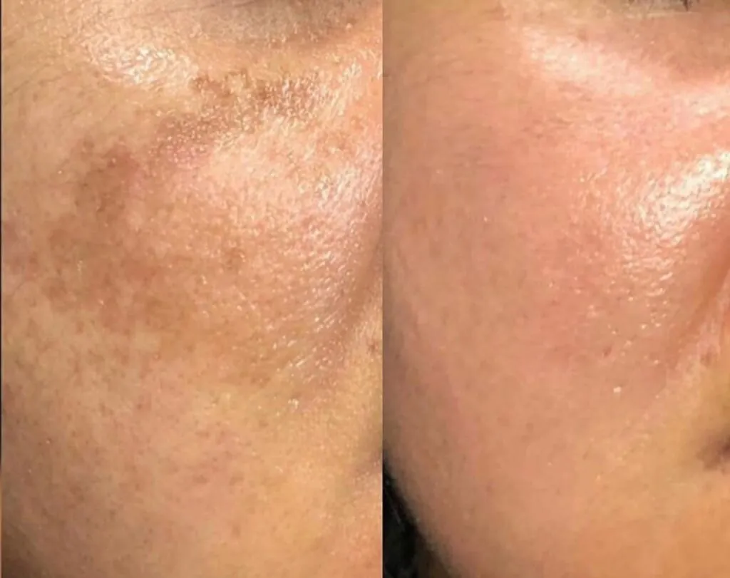 Microneedling viso e collo, Hello Beauty Roma