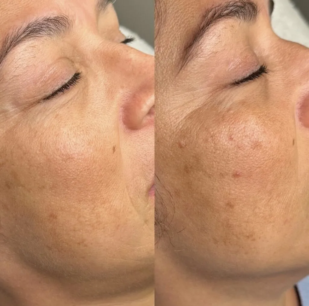 Microneedling viso e collo, Hello Beauty Roma