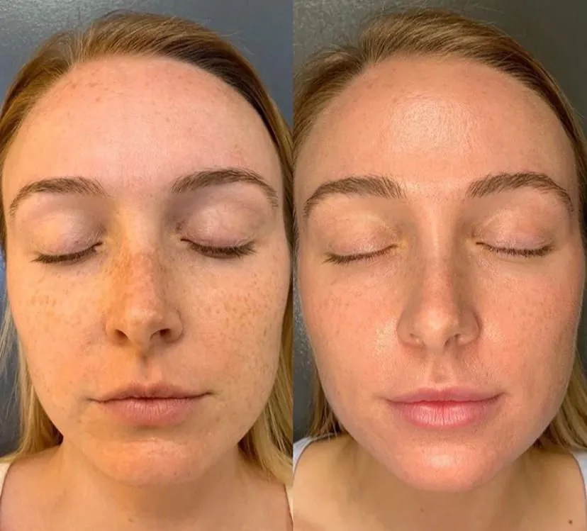 Hydrafacial e Endospheres Viso, Hello Beauty Roma