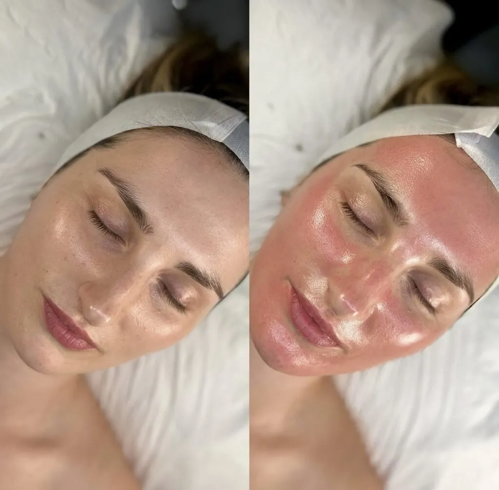 Microneedling con EXOSOMES - pacchetto da 3 sedute, Hello Beauty Roma