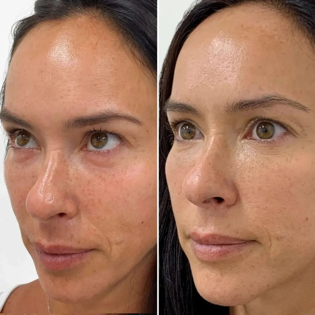 Microneedling con EXOSOMES - pacchetto da 3 sedute, Hello Beauty Roma