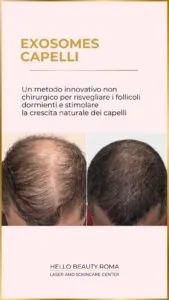 Microneedling Hair con Exosomes, Hello Beauty Roma