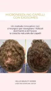 Microneedling Hair con Exosomes, Hello Beauty Roma