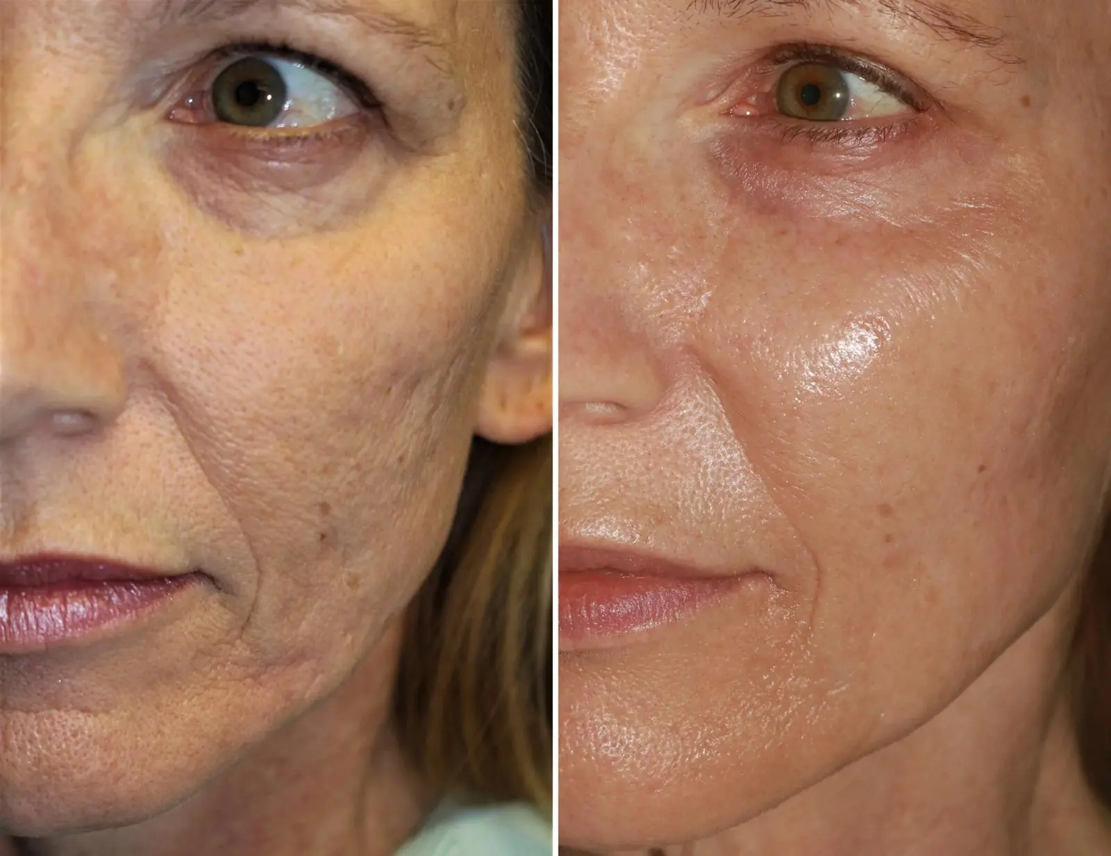 Microneedling con Esosomi + PDRN AMESON, Hello Beauty Roma