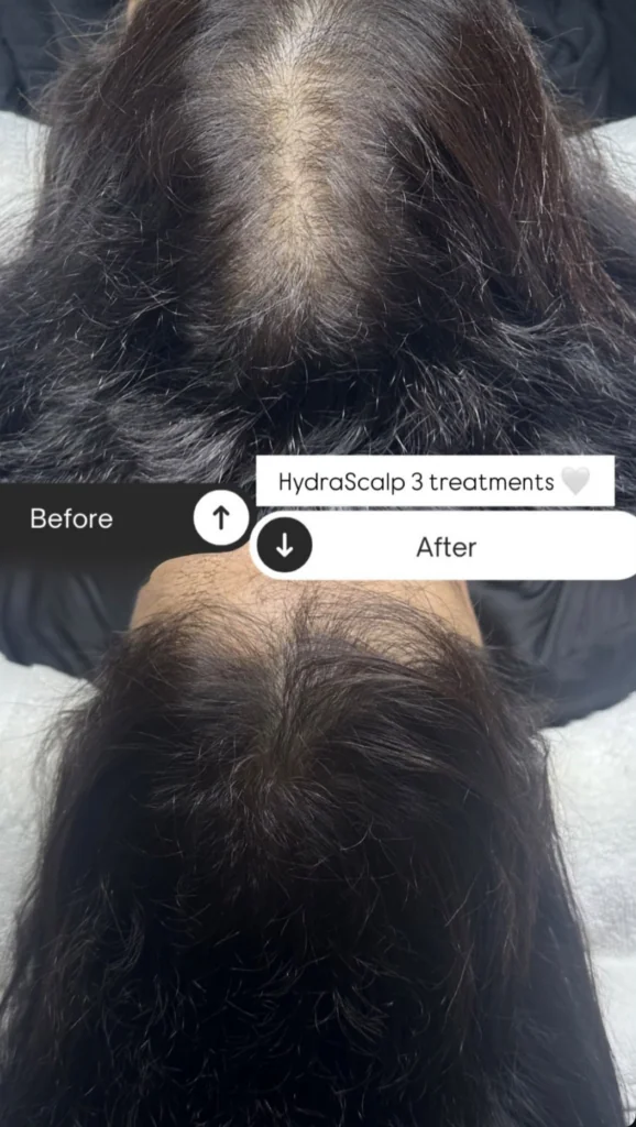 Hydrafacial Keravive, Hello Beauty Roma